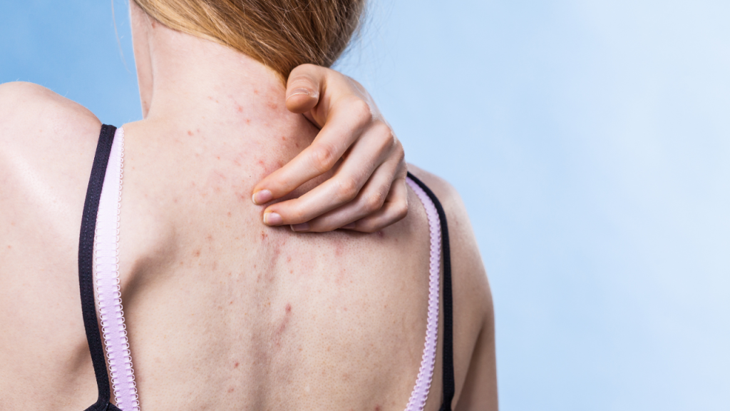Šta uzrokuje akne na leđima, nadlakticama i zadnjici?